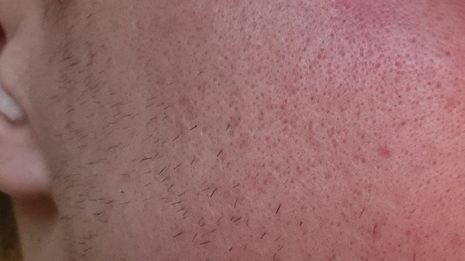 Skincare help, how to remove pores?