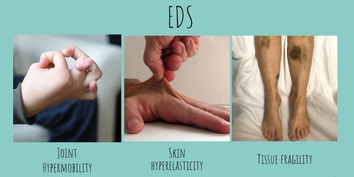 Do you suffer from (EDS) Ehlers-danlos Syndrome? If so, how does it affect you? What type do you have?