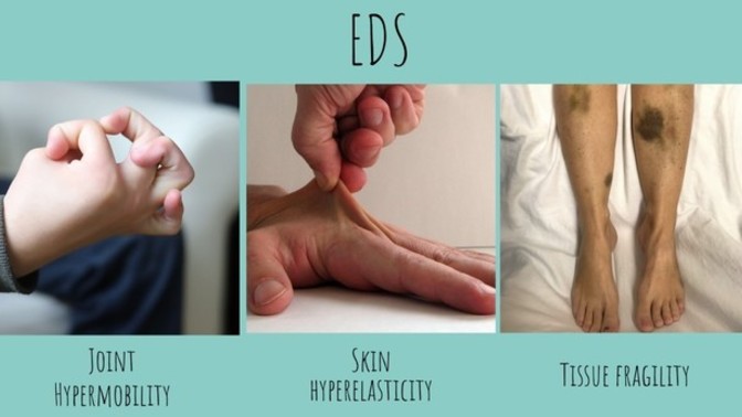 Do you suffer from (EDS) Ehlers-danlos Syndrome? If so, how does it affect you? What type do you have?
