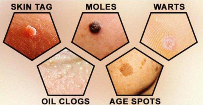 Is this a mole or a skin tag?