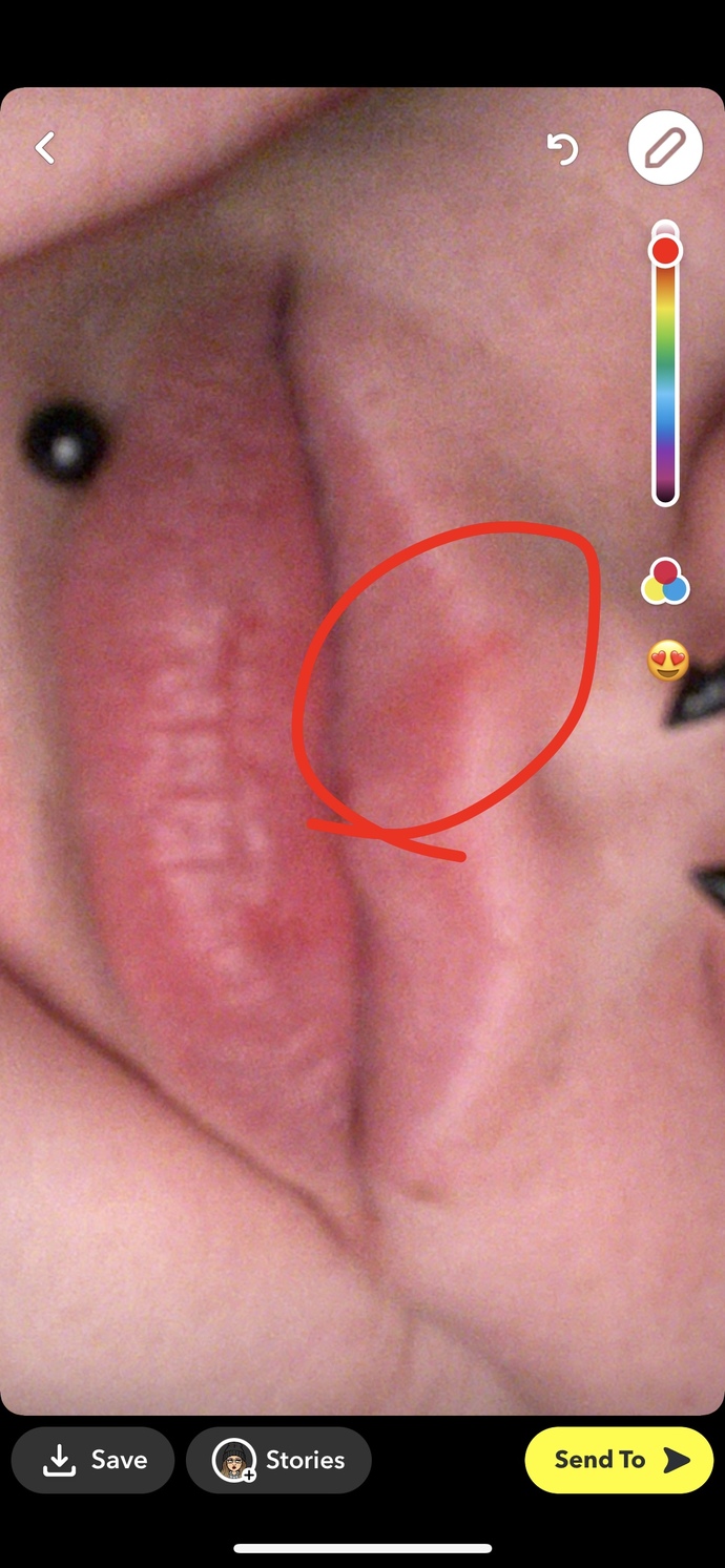 Cold sore or infected cut?