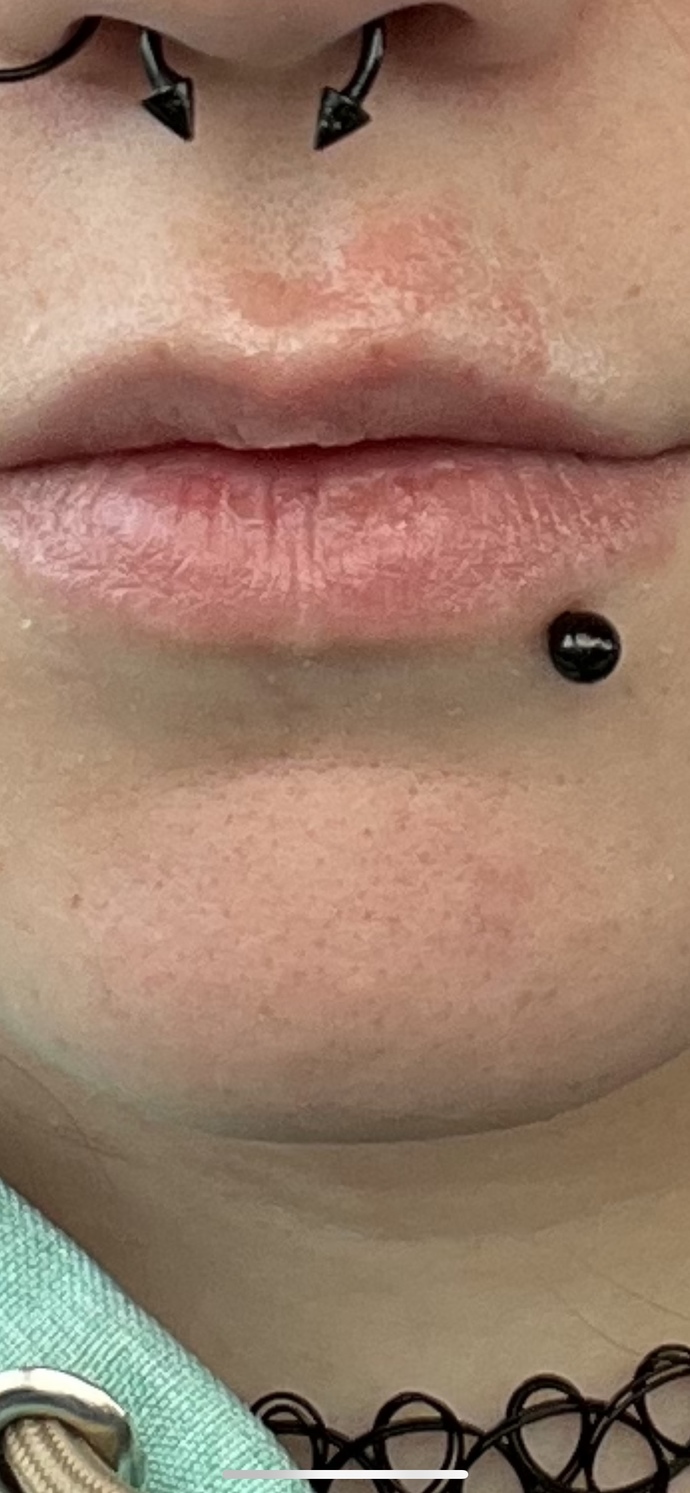 Cold sore or infected cut?