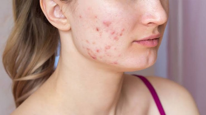 Would you date a woman with acne?