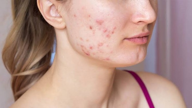 Would you date a woman with acne?