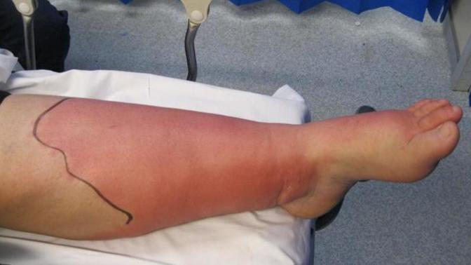 Have u ever had bacteria in your leg?