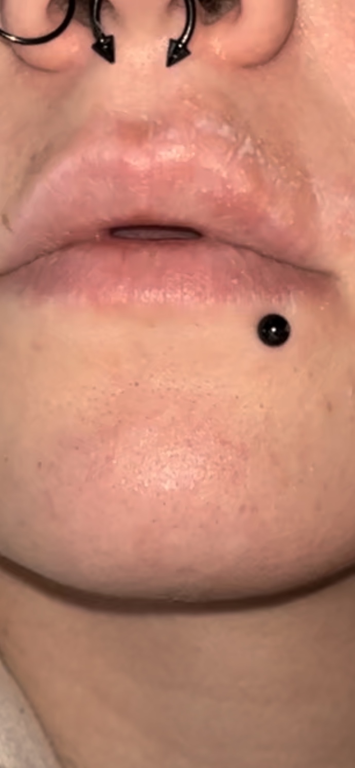 Cold sore itch URGENT HELP?