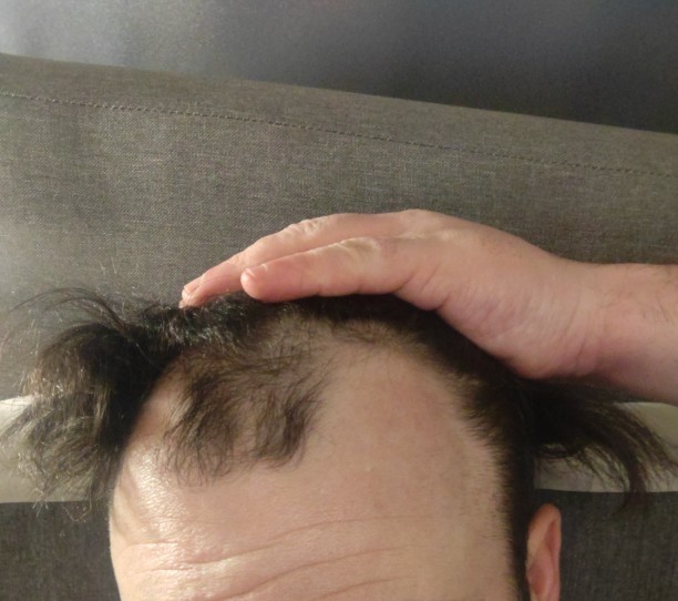 Considering getting a hair transplant, should I?