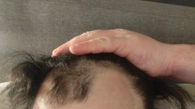 Considering getting a hair transplant, should I?