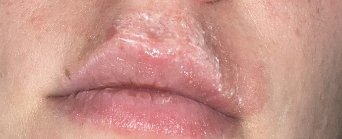 How long do cold sores stay this red for?