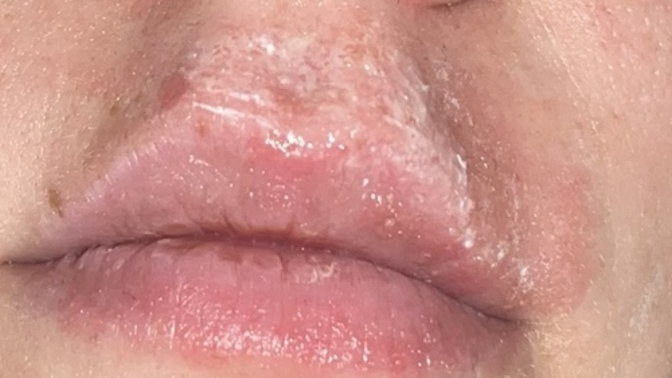 How long do cold sores stay this red for?