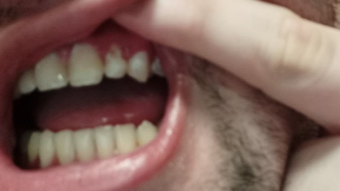 Can something help me deal with tooth dimineralization/dentin hypersensitivity?