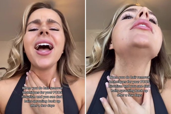 Whats worse to have - acne or facial hair (on ladies)?