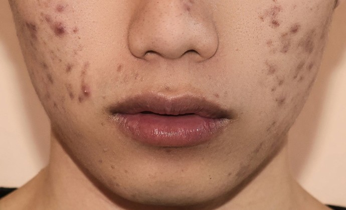 Whats worse to have - acne or facial hair (on ladies)?