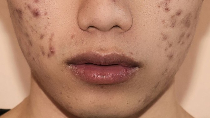 What's worse to have - acne or facial hair (on ladies)?