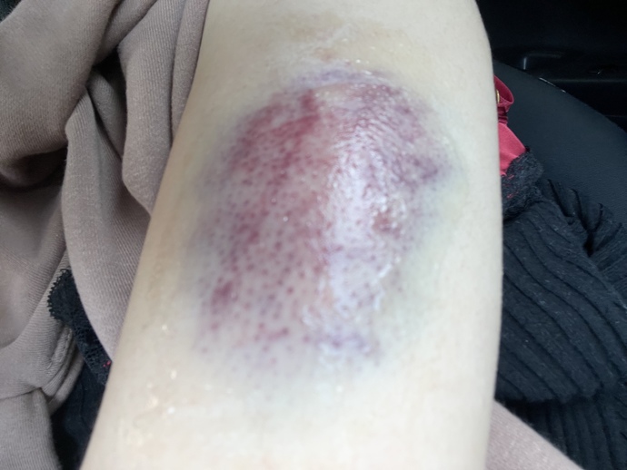 Should I go to the hospital for this kind of bruise I got or just but a bruise cream (pic)?