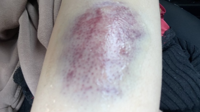Should I go to the hospital for this kind of bruise I got or just but a bruise cream (pic)?