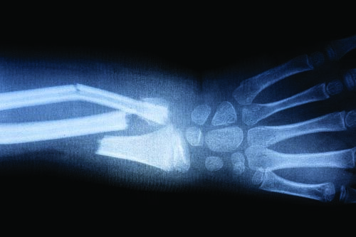 Do you enjoy breaking bones?