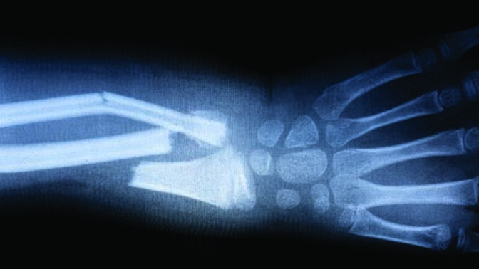 Do you enjoy breaking bones?