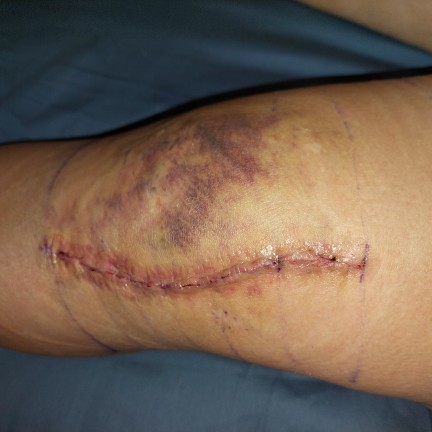 Anyone experience post surgery Depression?