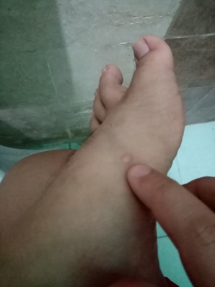If you have a blister, do you pop it?
