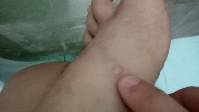 If you have a blister, do you pop it?