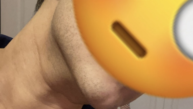 How can I lose the water retention in my face?