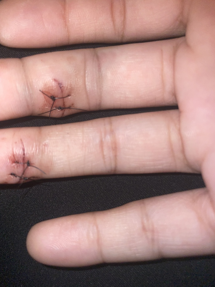 Will I have bad scaring (pic) got 2 stitches on both fingers?