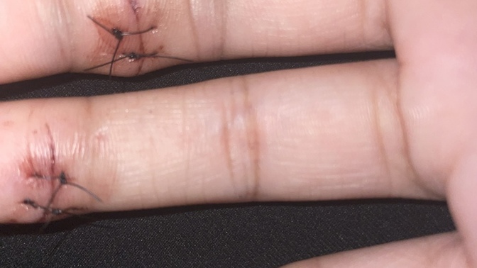 Will I have bad scaring (pic) got 2 stitches on both fingers?