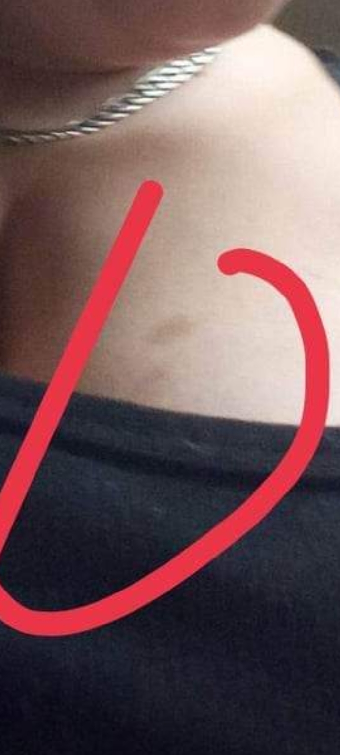 Bruise or hickey?