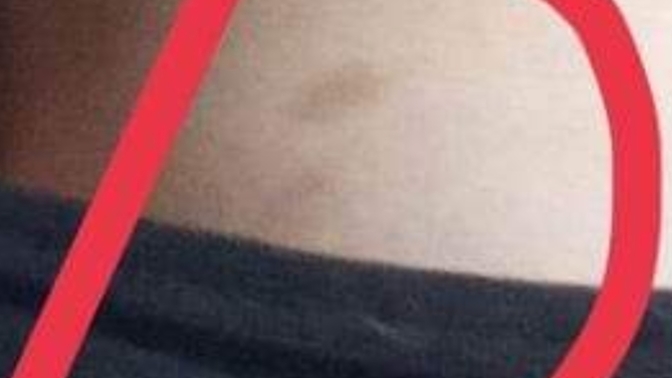 Bruise or hickey?