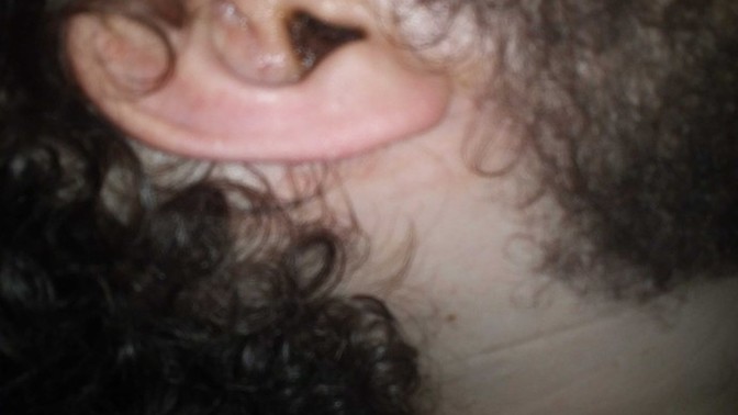 Hi so I have been getting excess earwax issues for a while now I'm considering microsuction what should I expect and is that safe?