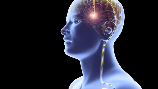 Elon Musk plans to chip people's brain who are disabled with certain medical condition, your thoughts, good, bad?