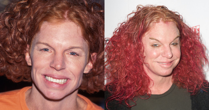 Before and after plastic surgery