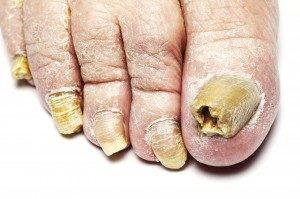 If you see the man or woman you like feet exposed and they have very ugly fungas toe nails, would you hold it against them and not like them anymore?