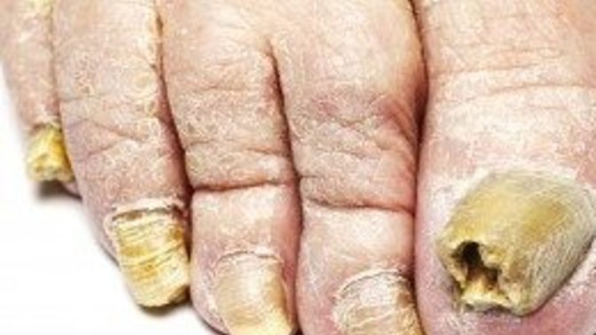 If you see the man or woman you like feet exposed and they have very ugly fungas toe nails, would you hold it against them and not like them anymore?