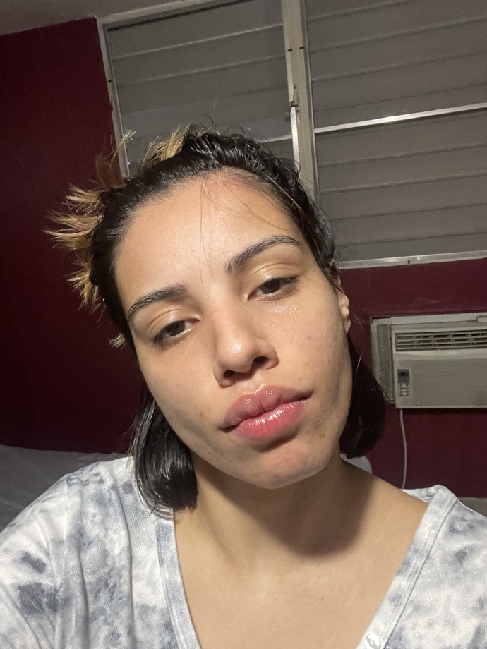 Is wearing sunscreen important for acne?
