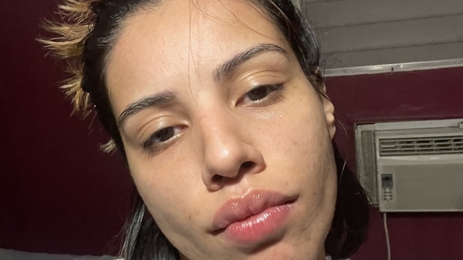 Is wearing sunscreen important for acne?