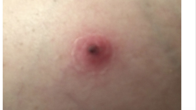 Ladies can you tell me if I should be worried about my breast and get it examined?