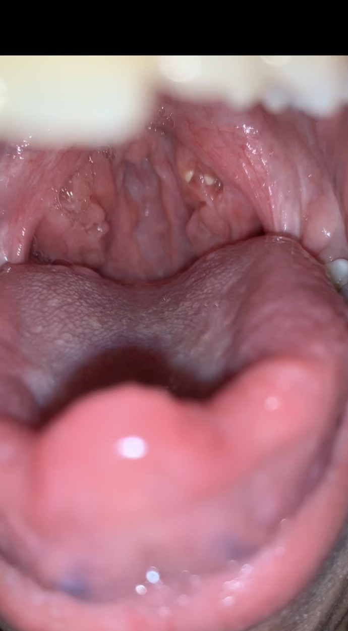 What are those 2 white dots back of my mouth?