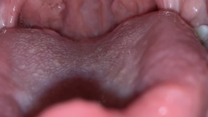 What are those 2 white dots back of my mouth?