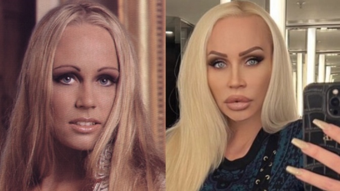 Does she look more beautiful before or after the cosmetic procedures?