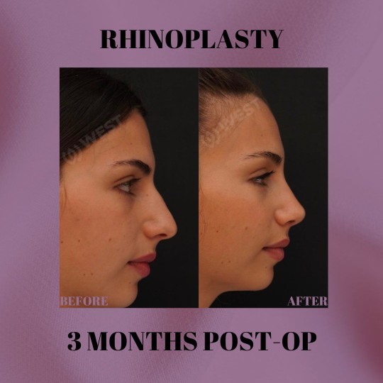 Which nose type do you like more?