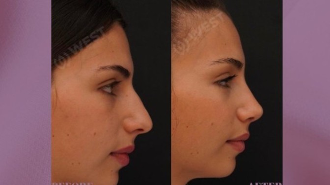 Which nose type do you like more?