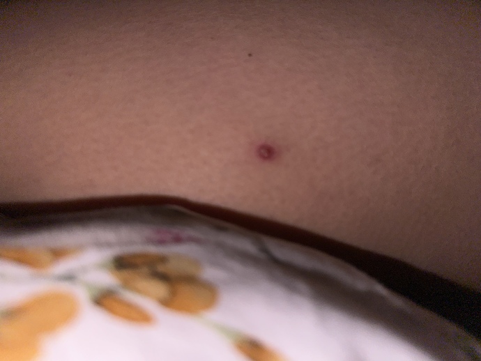 Hello, I have had this red pimple on my leg for about 4 months?