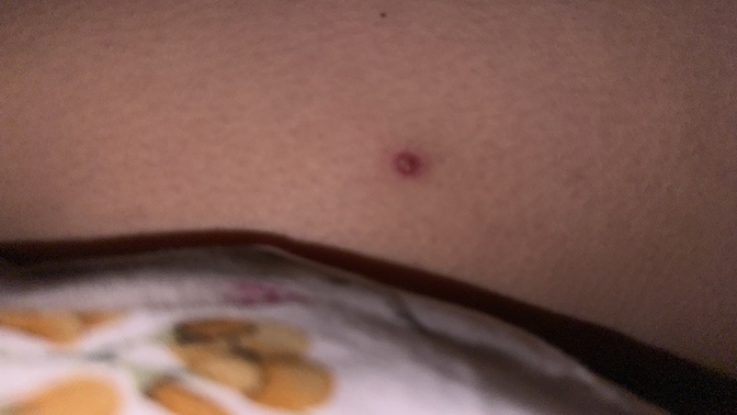 Hello, I have had this red pimple on my leg for about 4 months?
