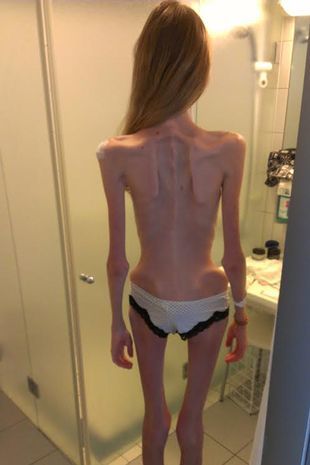 Sick with anorexia