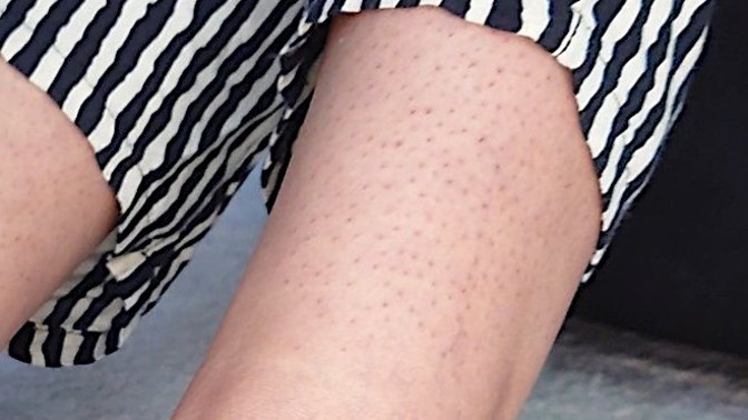 Is it normal and common for a girl to have such leg skin?