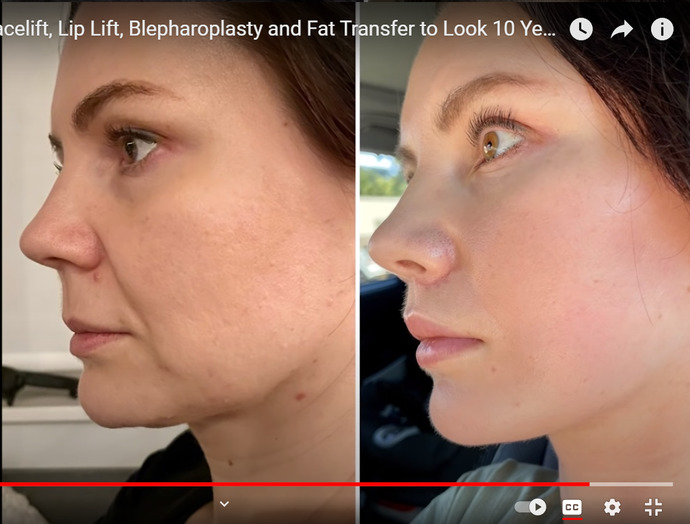 How young does this 41 year old woman look after plastic surgery?