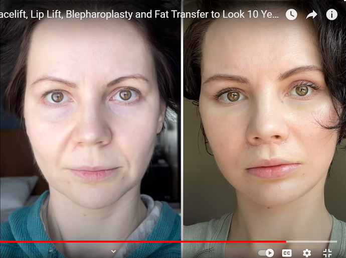 How young does this 41 year old woman look after plastic surgery?