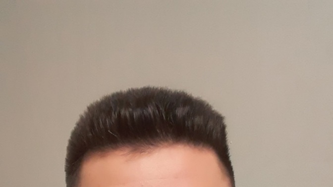 Friends and girls, how do you think my hairline is, will I go bald, do women like this hairstyle? ?